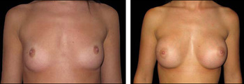 Breast implants - before and after
