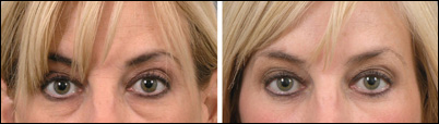 Eyelid surgery - before and after