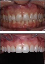 Ortoimplant: dental implants in Croatia