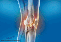 Steroid injection total knee replacement