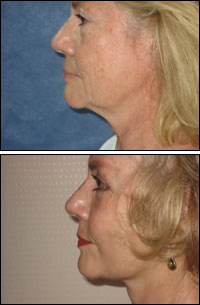 Facelift, before and after treatment
