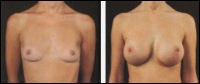 Breast augmentation - before and after treatment