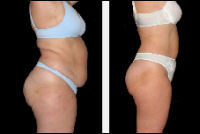Liposuction - before and after treatment