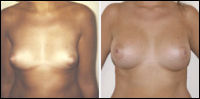 Breast augmentation - before and after treatment