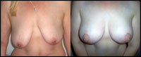 Breast uplift - before and after surgery