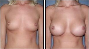 Before and after breast enlargement at Wellness Kliniek